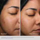 OBAGI - Retinol + PHA before and after