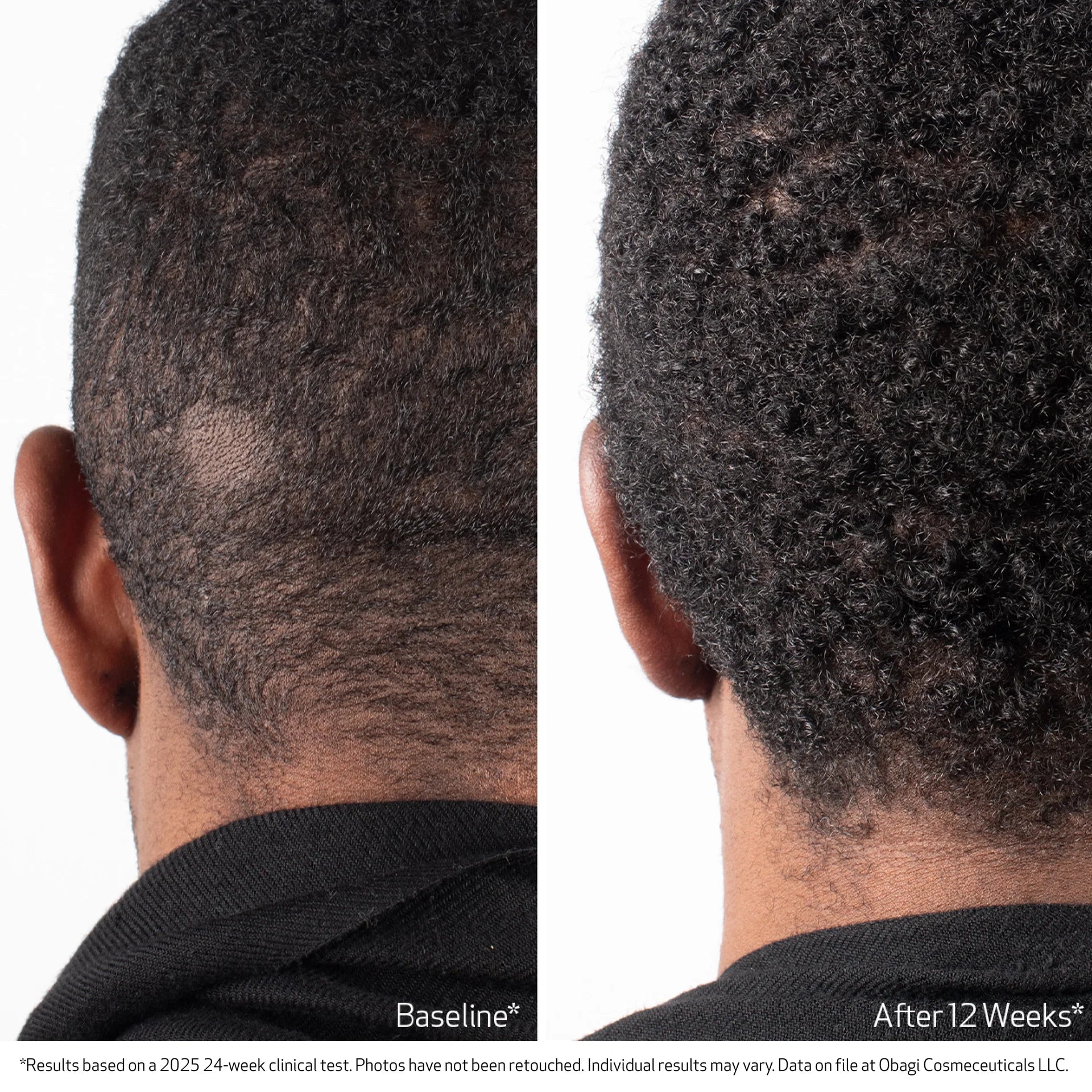 Obagi Nu Cil Scalp Serum male before and after