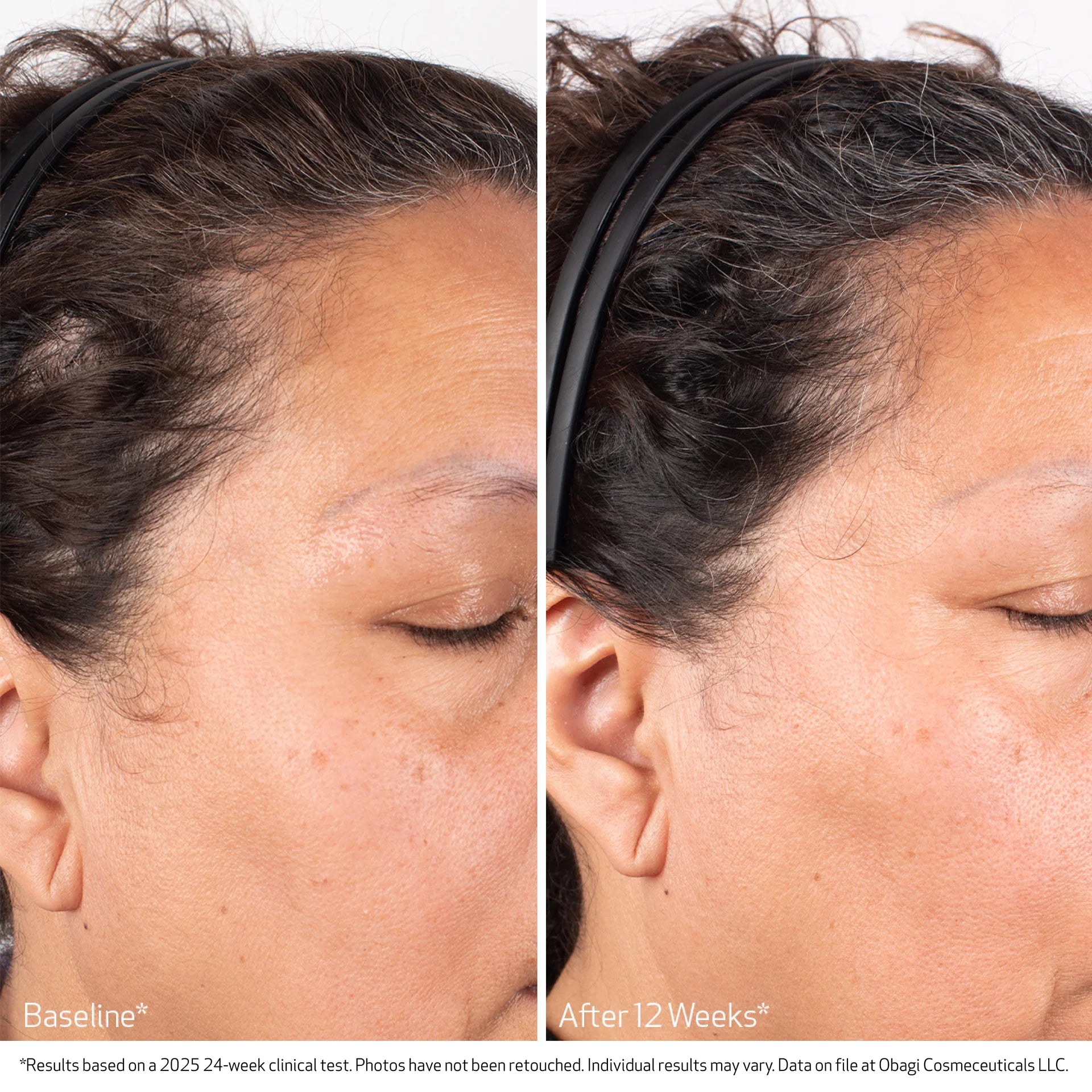 Obagi Nu Cil Scalp Serum before and after