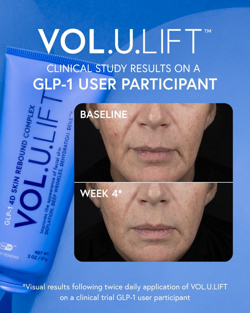 volulift before and after