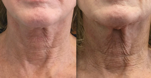 ALASTIN-before-after