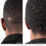 Obagi Nu Cil Scalp Serum male before and after 