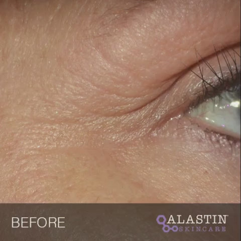 Alastin - Restorative Eye Treatment before and after